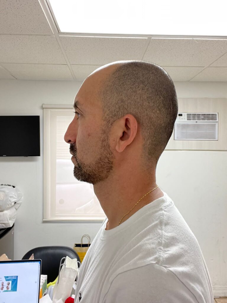 Before Hair Transplant Photo