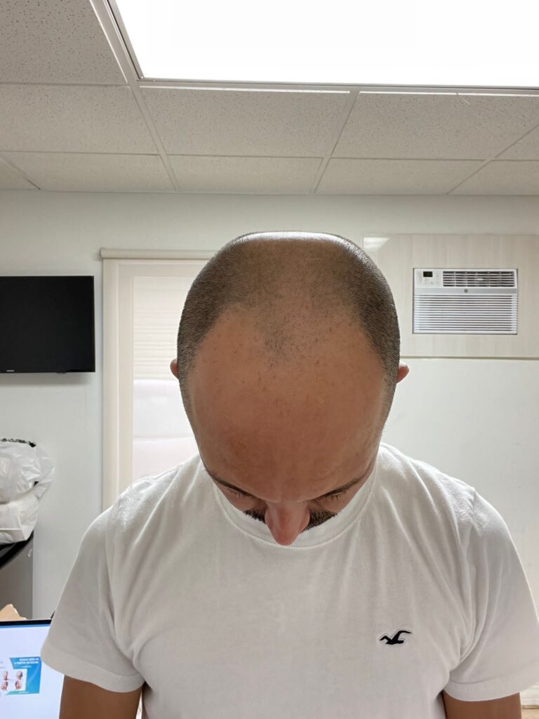 Before Hair Transplant Photo