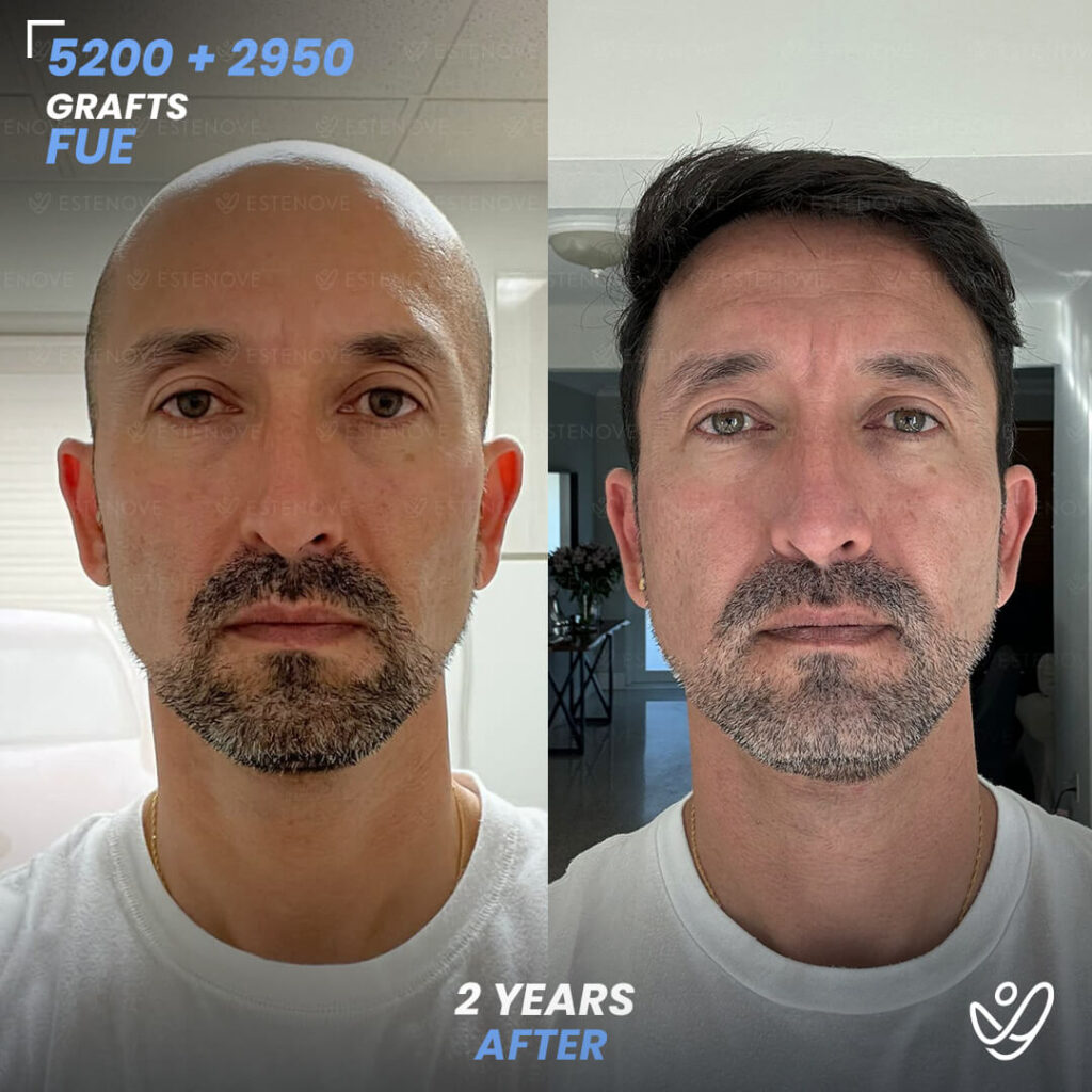 Second Hair Transplant Before After - FUE 5200 + 2950 Grafts - Wilmer Sanchez