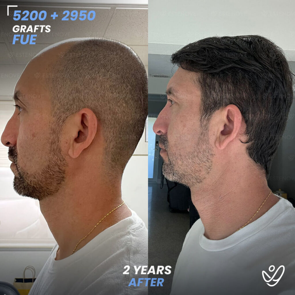 5200 + 2950 grafts FUE hair transplant before & after showcasing hair growth after hair transplant