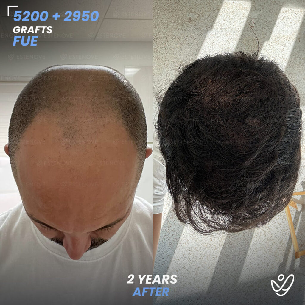 Second Hair Transplant Before After - FUE 5200 + 2950 Grafts - Wilmer Sanchez