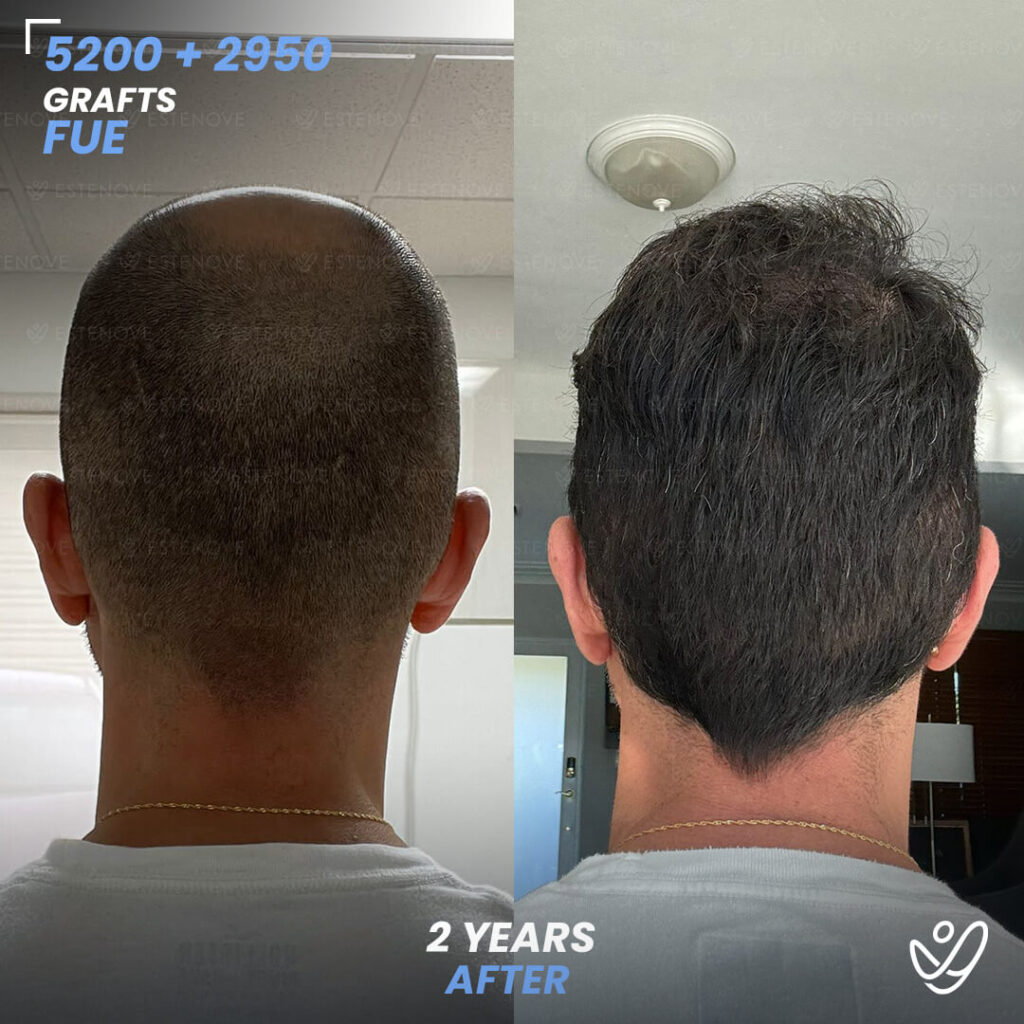 Second Hair Transplant Before After - FUE 5200 + 2950 Grafts - Wilmer Sanchez