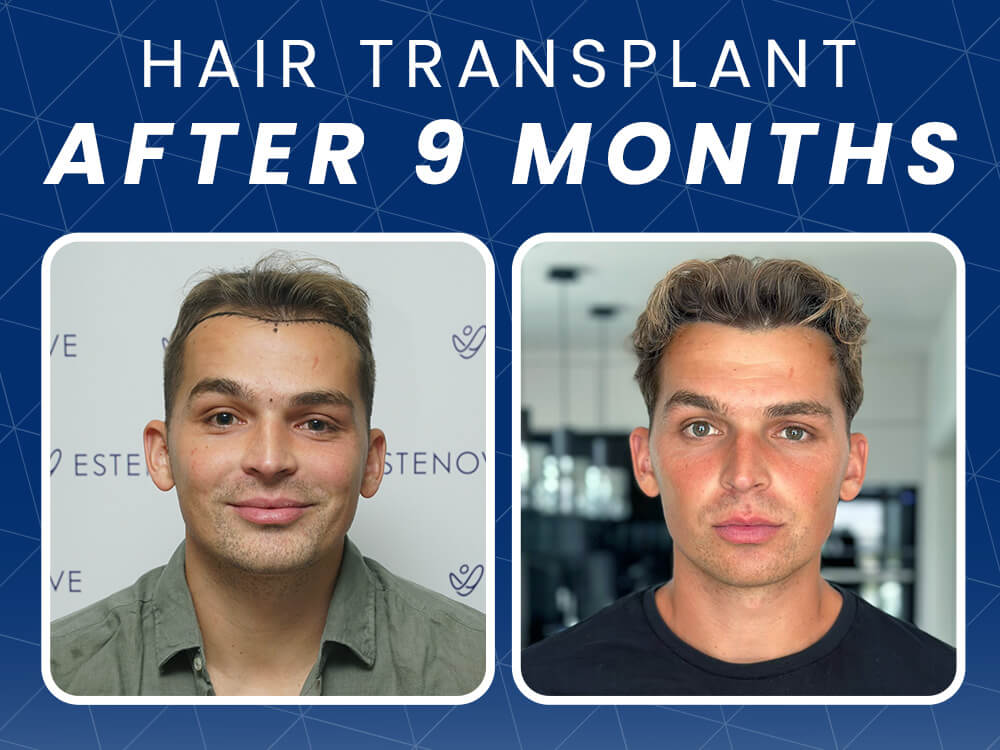 hair transplant results after 9 months