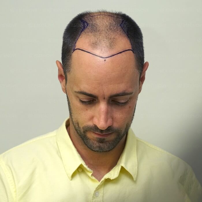 Before Hair Transplant