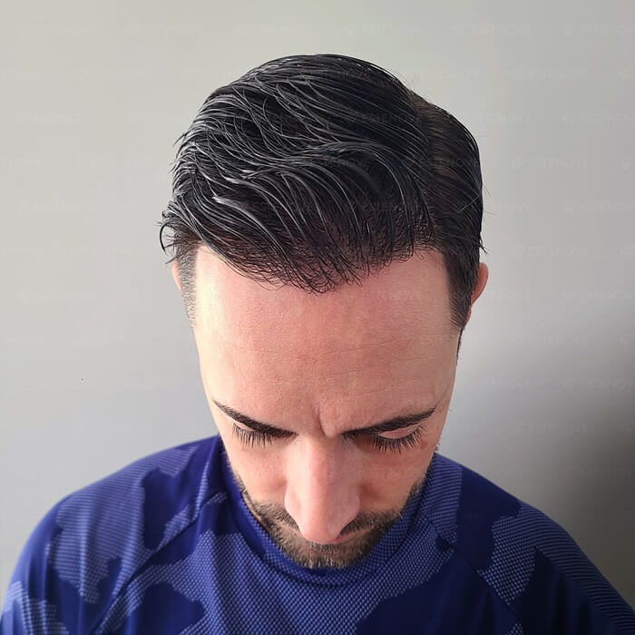 After Hair Transplant