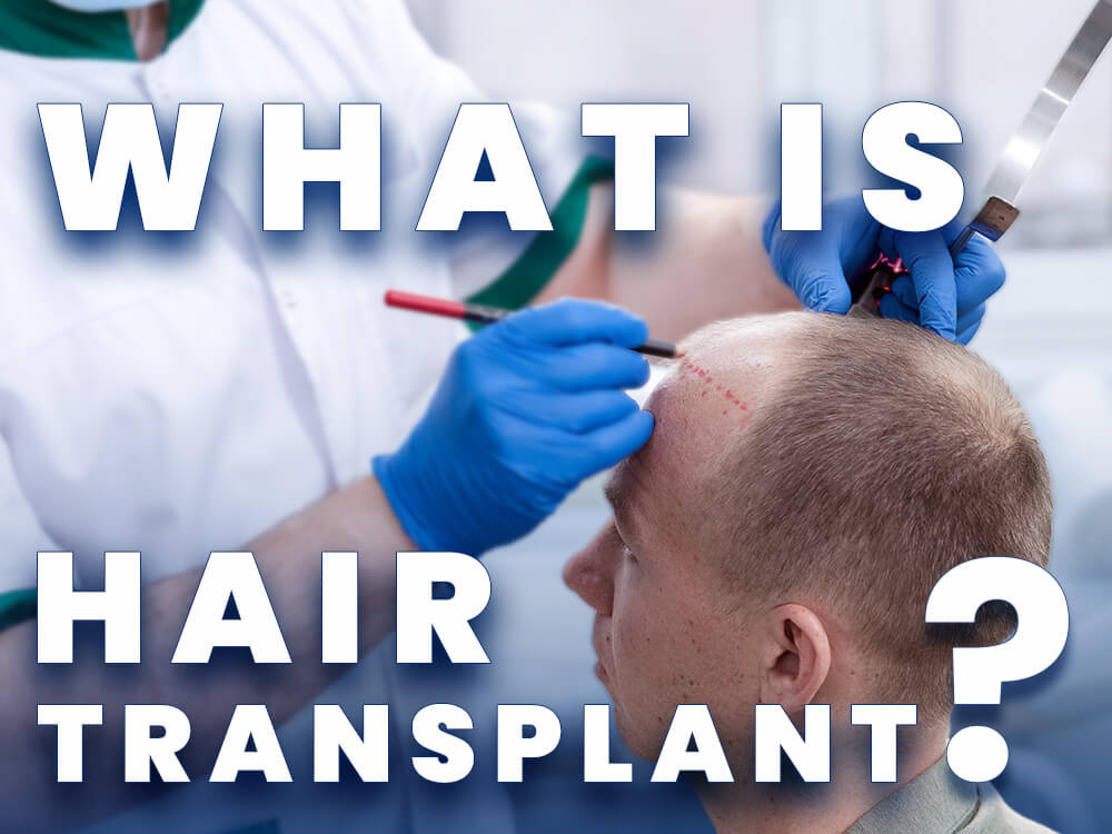 What is hair transplant and how does hair transplant work?