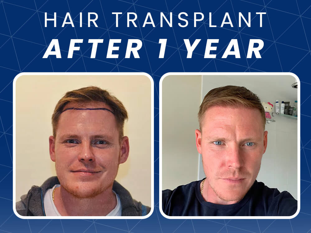 hair transplant results after 1 year