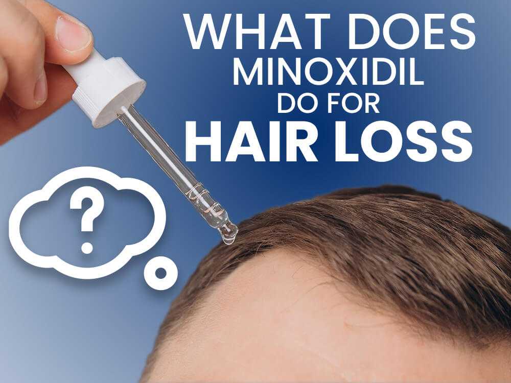 What does minoxidil do for hair loss