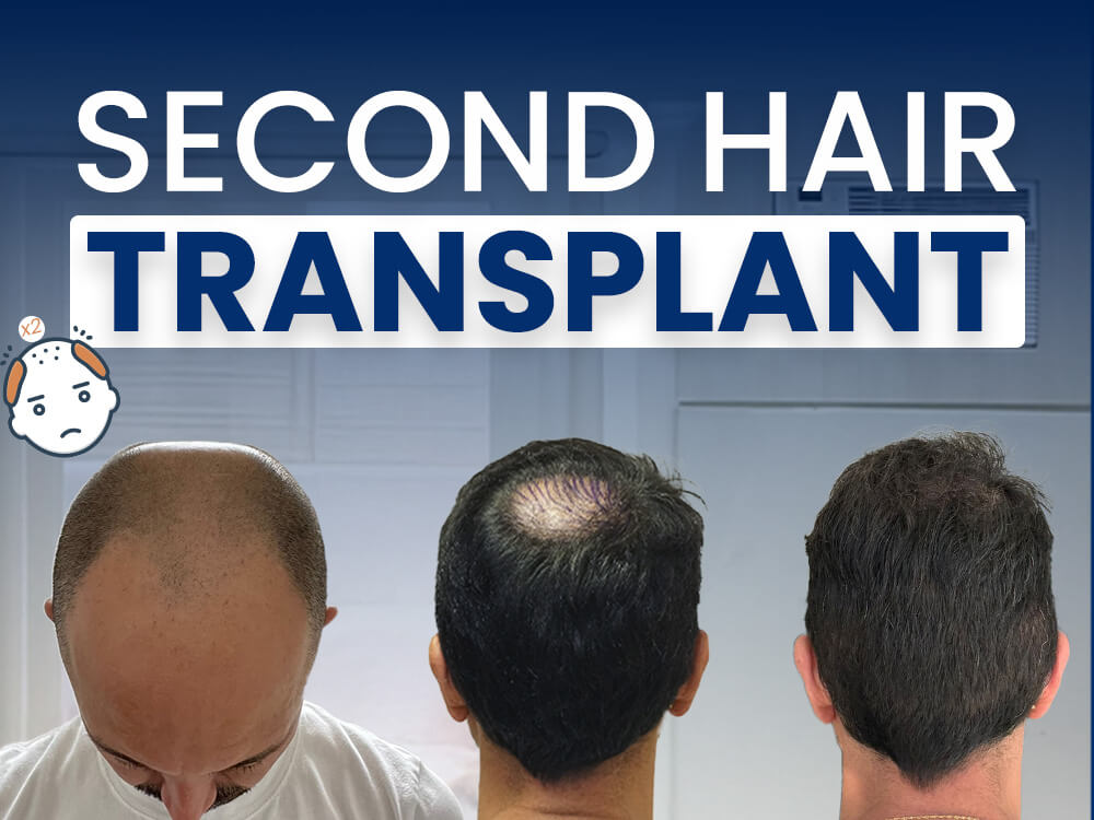 Second Hair Transplants Explained