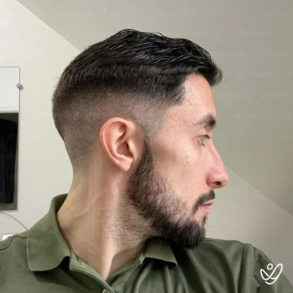 after hair transplant right side