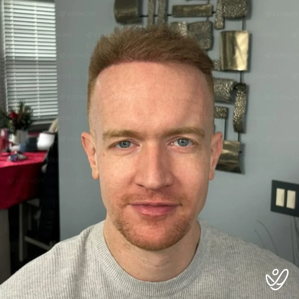 after hair transplant